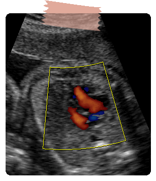 Doppler Fetal