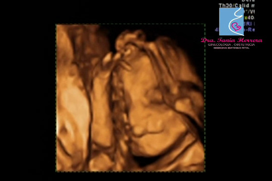 Es posible Detectar Labio Hendido durante la Ecografia estructural