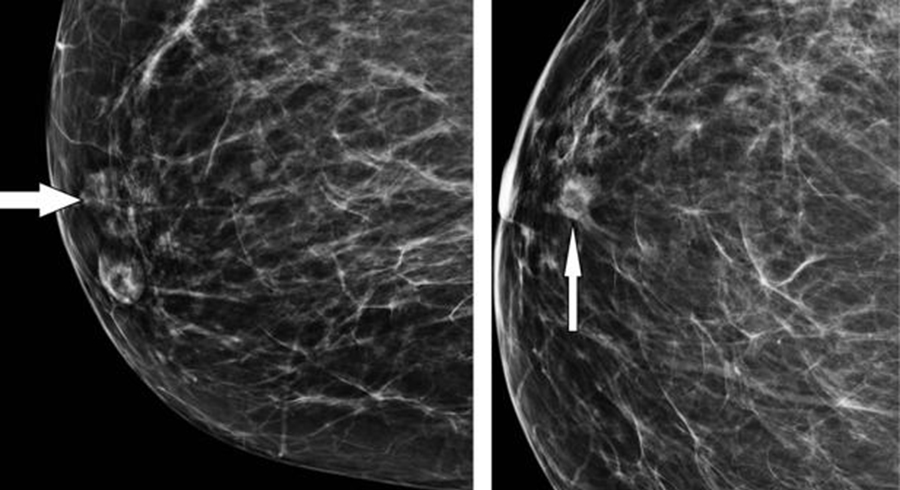 Cáncer de mama en Panamá: Un problema en crecimiento que puede frenarse con prevención